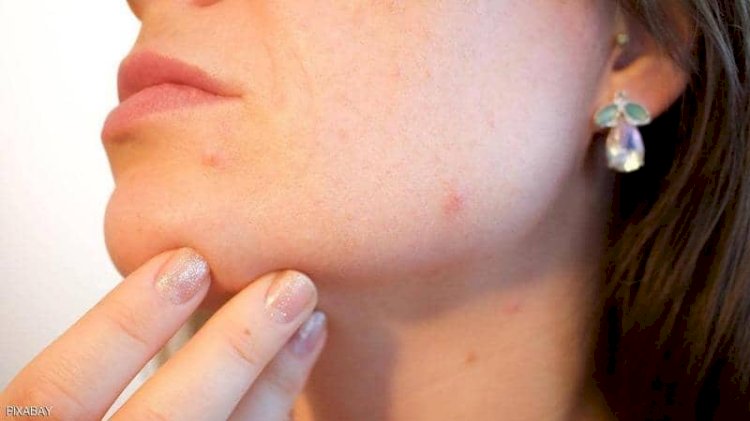 حب الشباب مشكلة تؤرق الكثير من المراهقين.