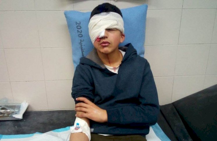 الطفل عز الدين نضال البطش 13 عاما أُصيب برصاص مطاطي في عينه 