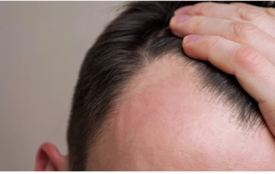 أدوية إنقاص الوزن قد ترتبط بتساقط الشعر لدى الرجال