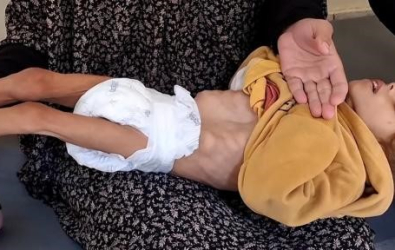 صحة غزة: 466 شهيداً بينهم 157 طفلًا جراء سوء التغذية والتجويع