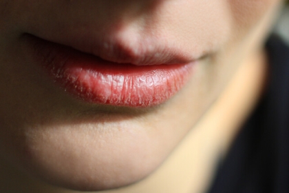 أربع أسباب صحية مقلقة وراء تشقق الشفاه