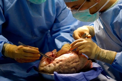 لأول مرة.. أطباء إسبان ينجحون بزراعة رئة بتقنية رائدة