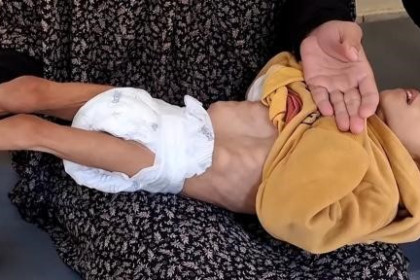 صحة غزة: 466 شهيداً بينهم 157 طفلًا جراء سوء التغذية والتجويع