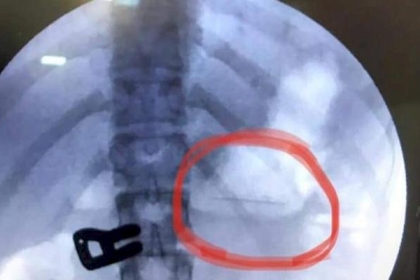 غزة: استخراج دبوس بطول 2سم بالمنظار من معدة فتاة