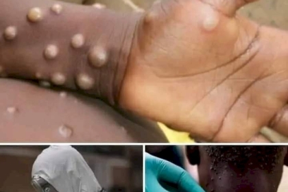 الصحة العالمية تعقد اجتماعًا طارئا لبحث تفشّي "جدري القردة"