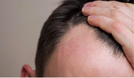 أدوية إنقاص الوزن قد ترتبط بتساقط الشعر لدى الرجال