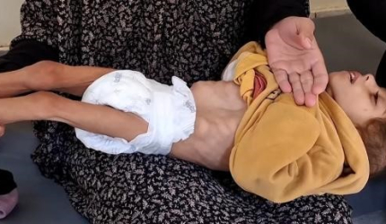 صحة غزة: 466 شهيداً بينهم 157 طفلًا جراء سوء التغذية والتجويع