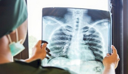 دواء جديد لعلاج سرطان الرئة يثبت فعاليته بكفاءة أكثر من الكيميائي